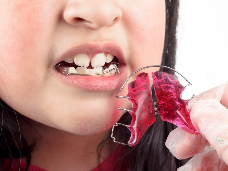 Çocuklar için Ortodonti Tedavisi, Çocuk Ortodonti Klinikleri İstanbul