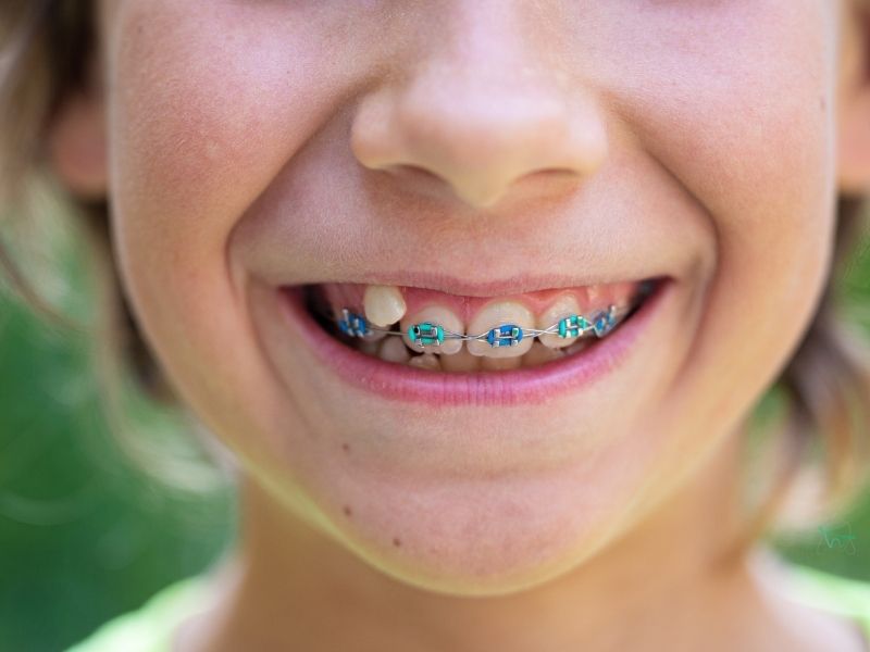 Çocuklar için Ortodonti Tedavisi, Çocuk Ortodonti Klinikleri İstanbul